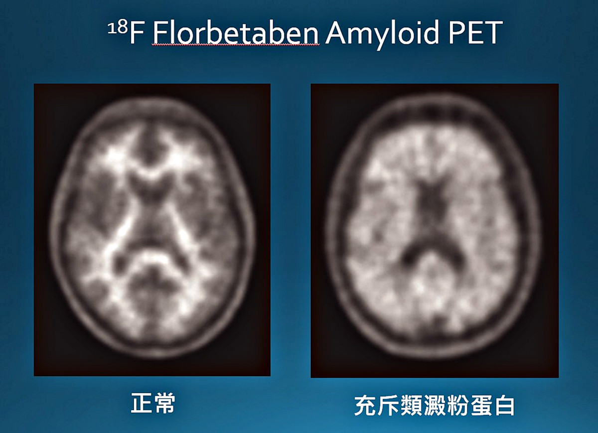 類澱粉蛋白正子造影檢查，圖左為正常的大腦影像，圖右顯示腦內充斥類澱粉蛋白