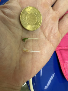 61歲張先生因持續胸痛就醫，經一連串檢查，竟發現食道卡了兩根銅板大小的魚刺。圖片提供／台中醫院