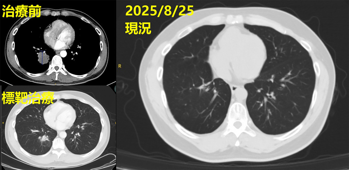 經治療後影像追蹤可見，原近4公分腫瘤明顯消失，病情獲得良好控制。圖／彰基醫院提供