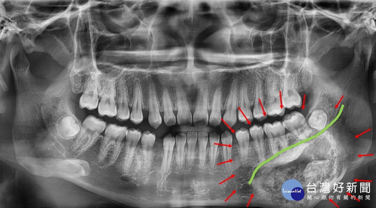 3D列印打造精準顎骨重建,秀傳醫療團隊助少女找回笑容。圖/記者鄧富珍攝