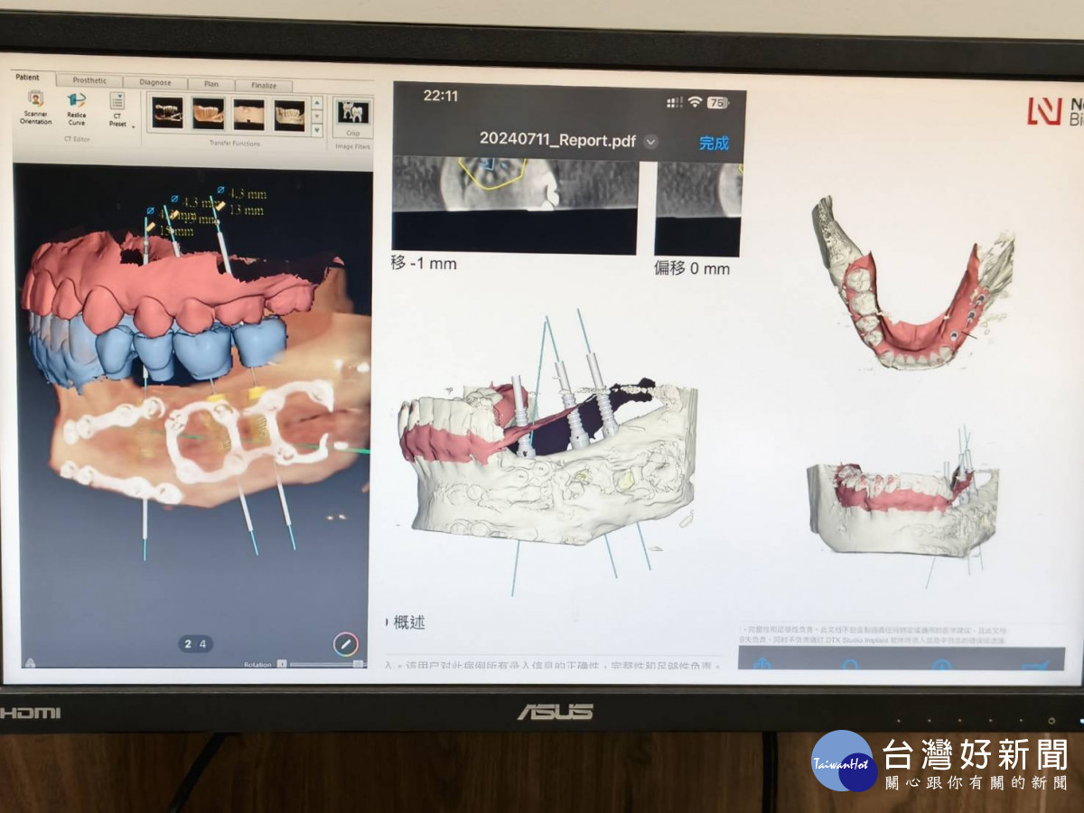 3D列印打造精準顎骨重建,秀傳醫療團隊助少女找回笑容。圖/記者鄧富珍翻攝
