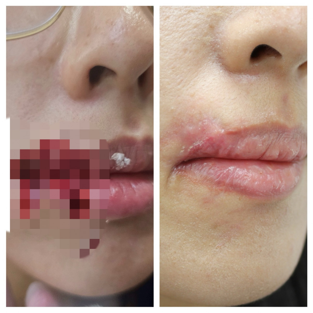 28歲胡小姐遭愛犬咬傷臉部,造成嘴邊皮膚與肌肉撕裂缺損。