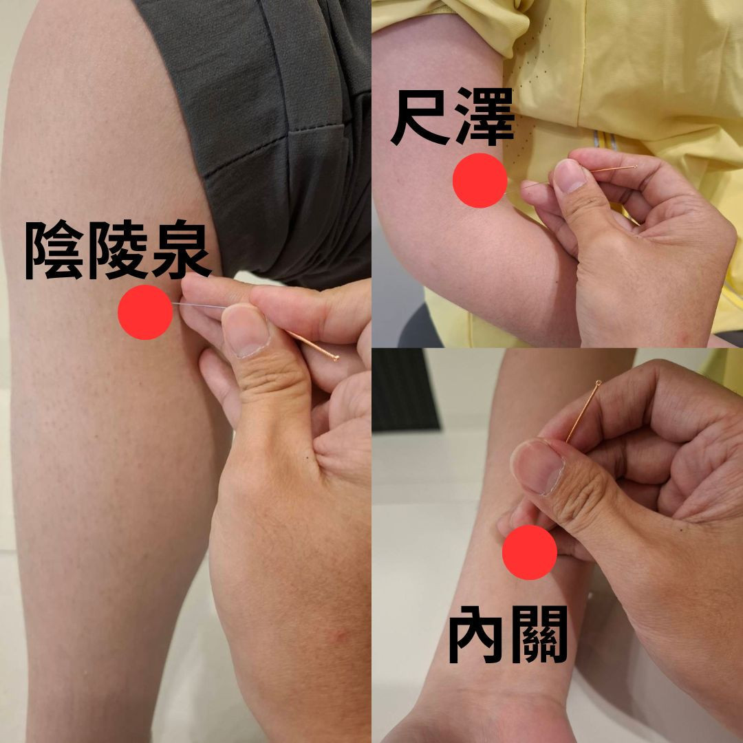 常用針灸穴位如尺澤穴、內關穴、陰陵泉穴等。針灸屬自然恢復方式,對於症狀仍在早期、擔心手術風險或偏好保守治療的民眾相當適合。