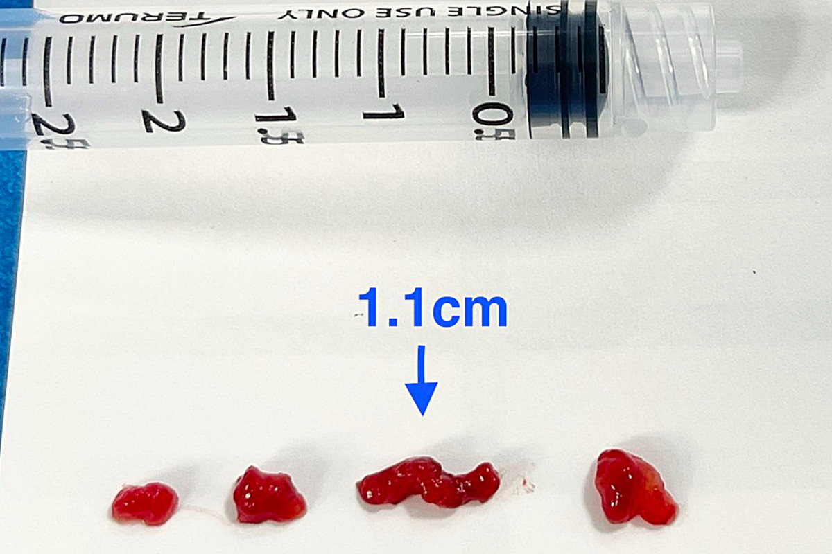 14歲孩子心臟藏7公分「炸彈」 10分鐘緊急完成顱內取栓救回大腦