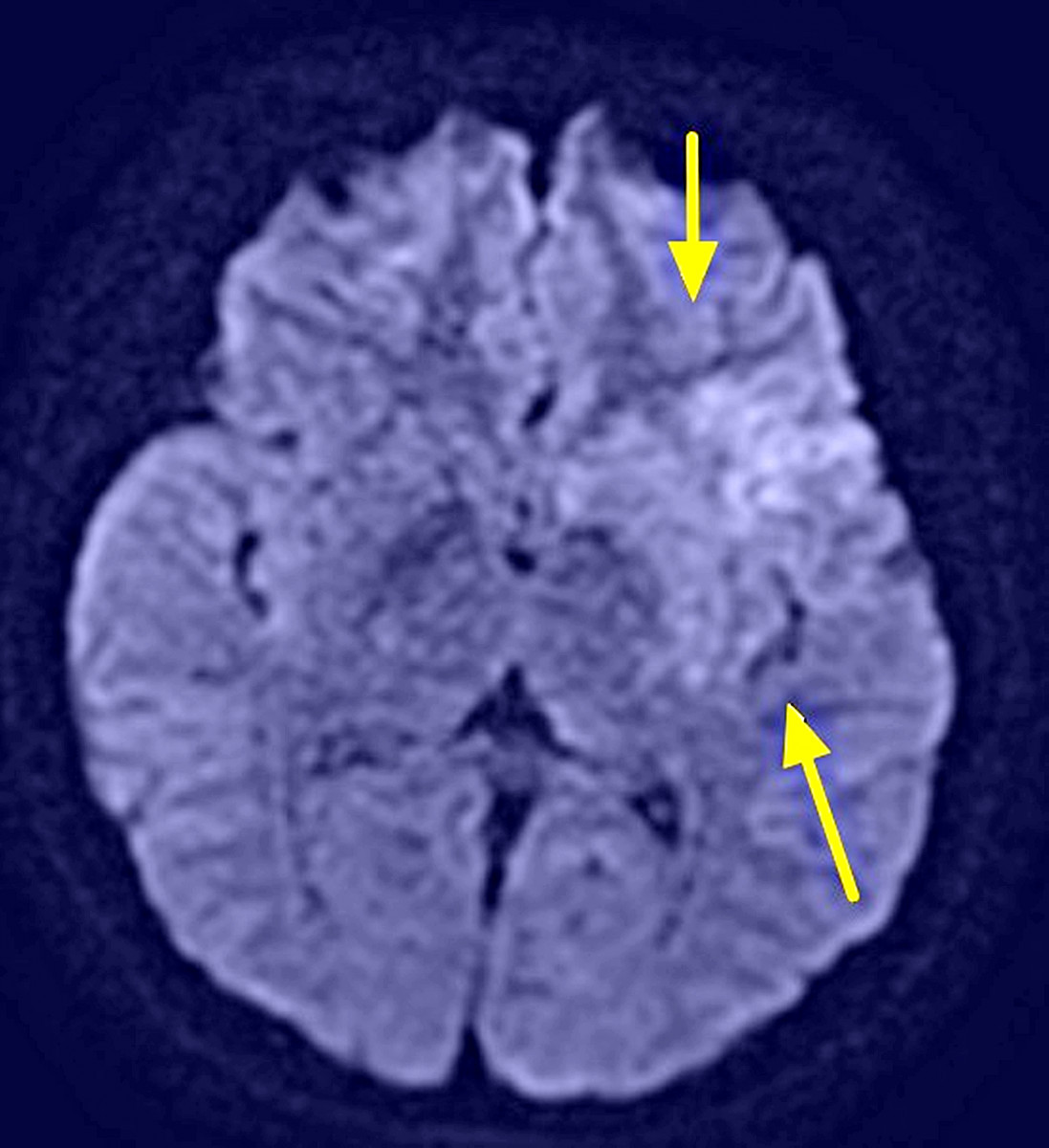 核磁共振影像,箭頭處呈現早期缺血變化