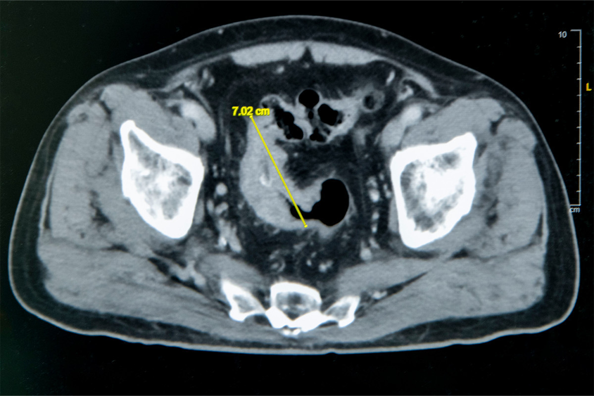 老翁罹患乙狀結腸癌，腫瘤約7公分造成腸子幾乎完全阻塞。圖／彰基醫院提供