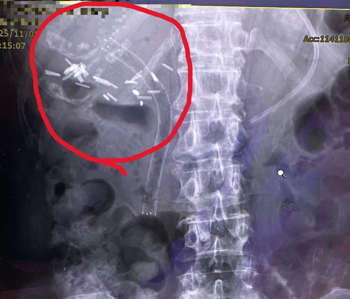 罹癌婦人發燒、噁心送急診  檢查：膽管道塑膠支架阻塞引起