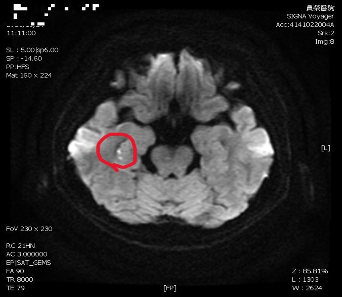 女子喪禮上反覆問同樣問題事後不記得   醫師揪出隱形中風短暫性全面失憶症