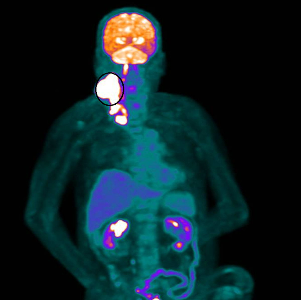 健保也能創造奇蹟 80歲癌末患者放射治療逆轉困境