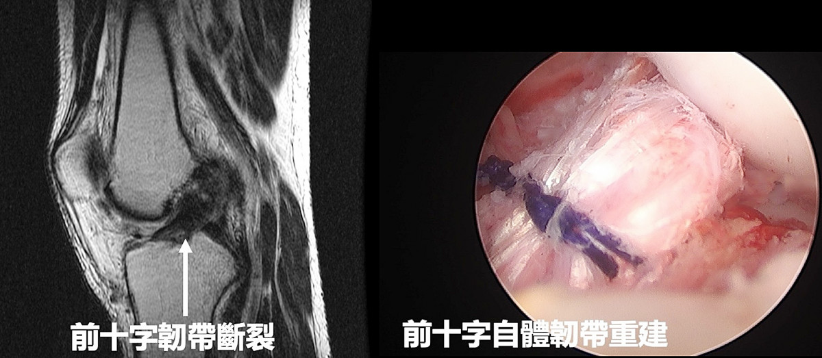 前十字韌帶斷裂前與手術重建