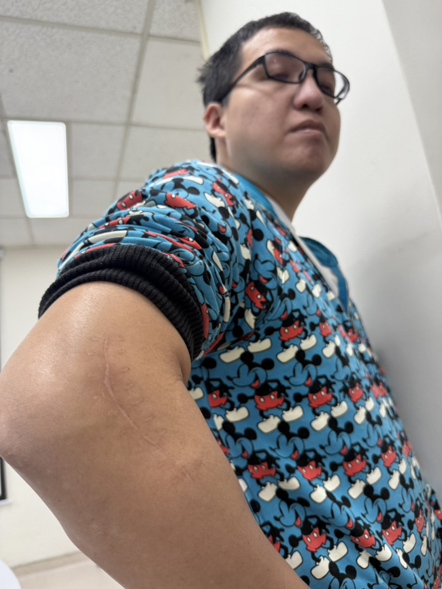 36歲尤先生漏出當初粉碎性骨折的右手關節，傷口疤痕平整幾乎看不出來。