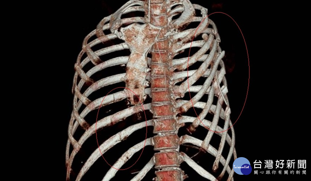 埔鹽驚悚車禍九死一生　搶回一命卻斷片