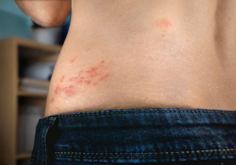 季節交替「皮蛇」好發　中西醫整合治療提升免疫力成關鍵