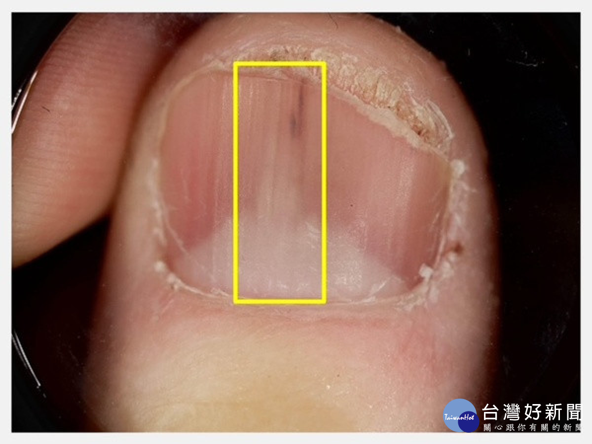 指甲也會長腫瘤？　皮膚科醫師提醒「這些變化」別忽視
