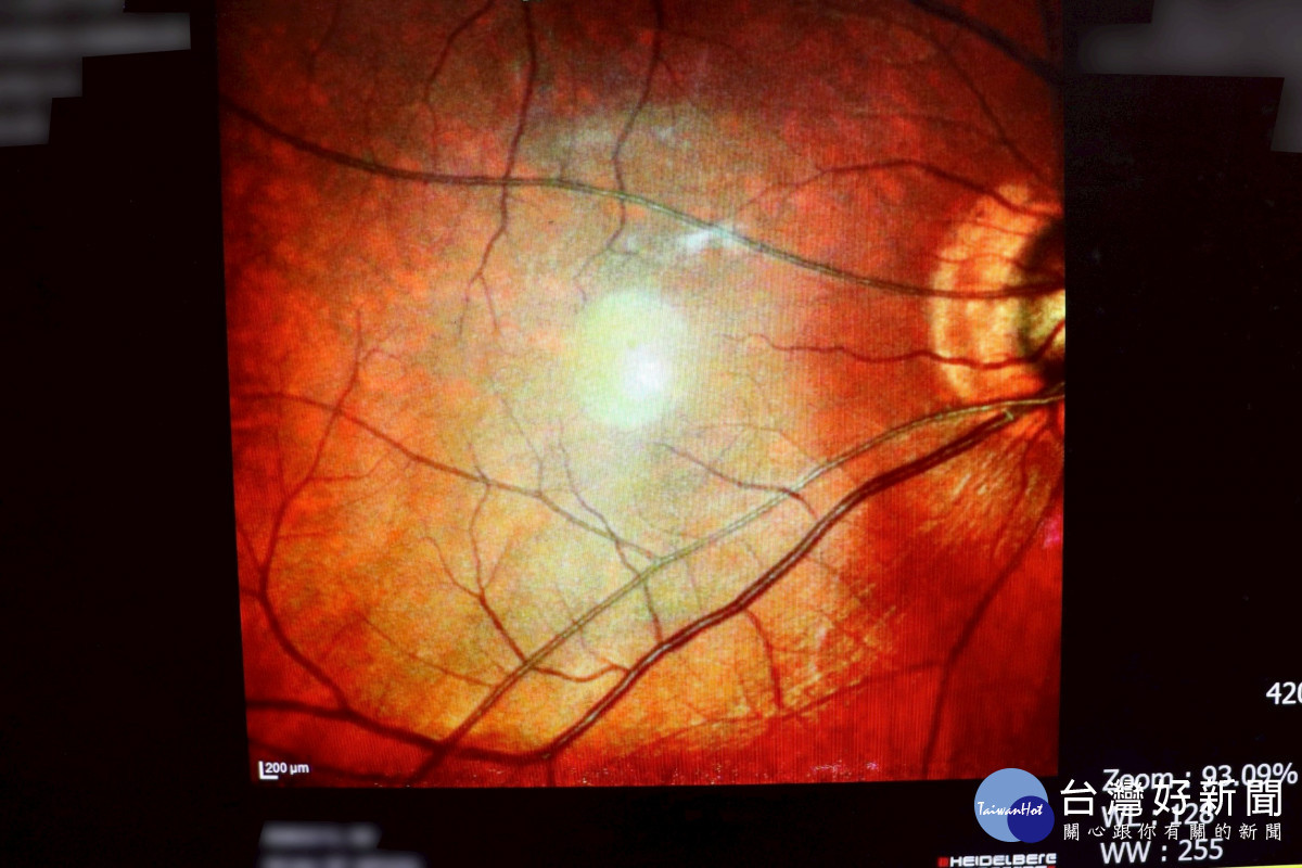 聯新國際醫院定期為糖友安排眼底鏡篩檢，降低視神經病變風險