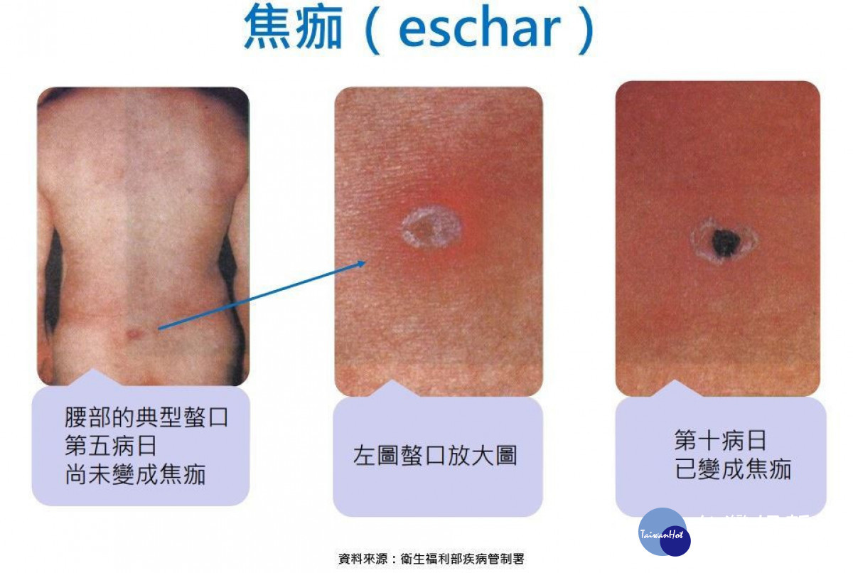 恙蟲宣導單張(焦痂)。