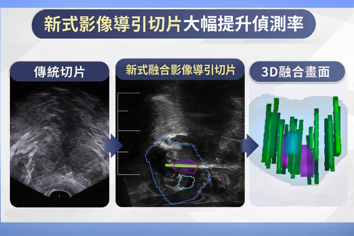 攝護腺癌早期無症狀，傳統切片恐有偽陰性；MRI融合影像導引切片可精準取樣，大幅提升偵測率。圖／彰基醫院提供