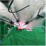 右側耳後切口的達文西腮腺手術。