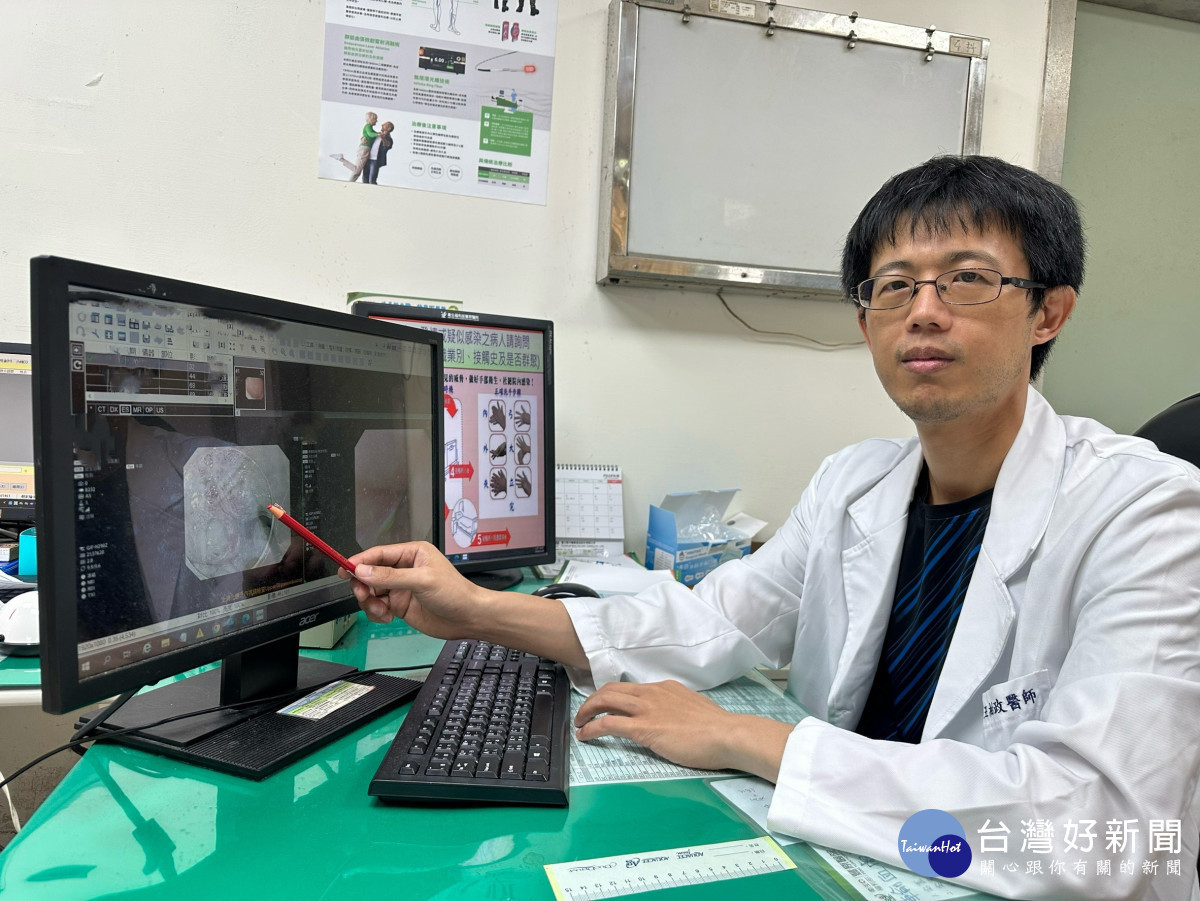肝膽腸胃科醫師王柏政表示,食道癌若能在癌前病變或早期癌階段及早發現並介入治療,往往可大幅提升治療成效,甚至免除大型手術,可透過「內視鏡下腫瘤剝離術」方式切除病灶,避免傳統食道切除手術。