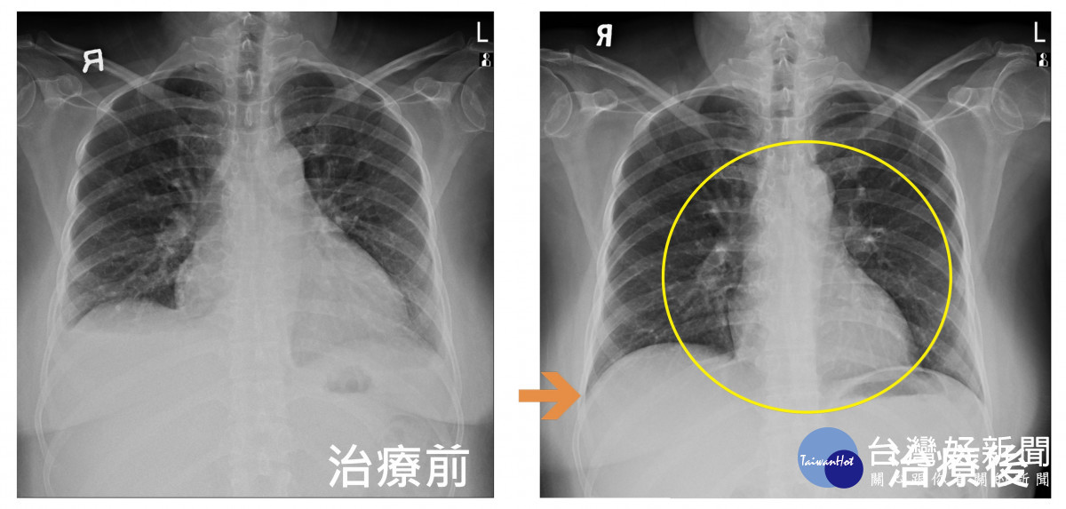 圖左為接受心臟衰竭治療前的x光，心臟擴大與雙側肋膜積水，圖右為接受心衰竭治療後，心臟擴大(黃圈處)與肋膜積水(箭頭處)皆已改善