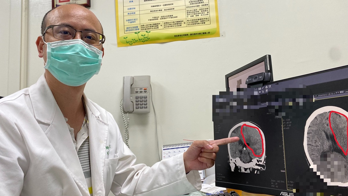 原要換膝關節竟變「緊急開腦」　跨科團隊及時攔截隱形殺手救回婦人