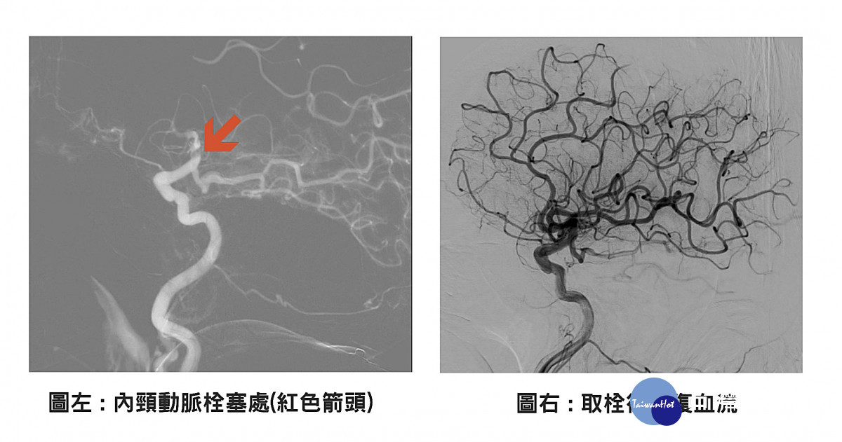 左圖紅色箭頭處為內頸動脈栓塞處,右圖為取栓後恢復血流