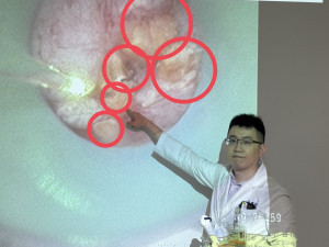 簡維宏醫師說明輸尿管進入患者腎臟時發現散佈腎臟內的雷氏斑（紅圈處）。圖/台中醫院提供