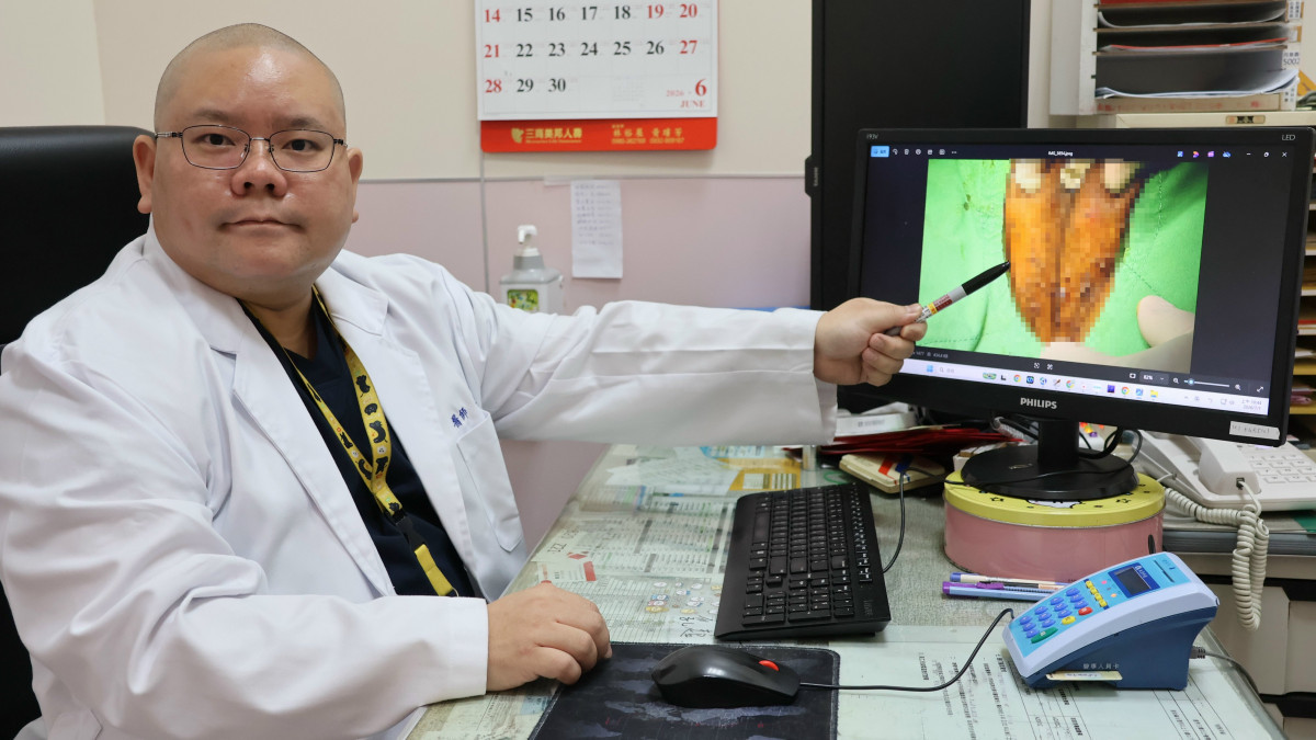 30歲男下體長菜花拖2年　竟冒出103顆
