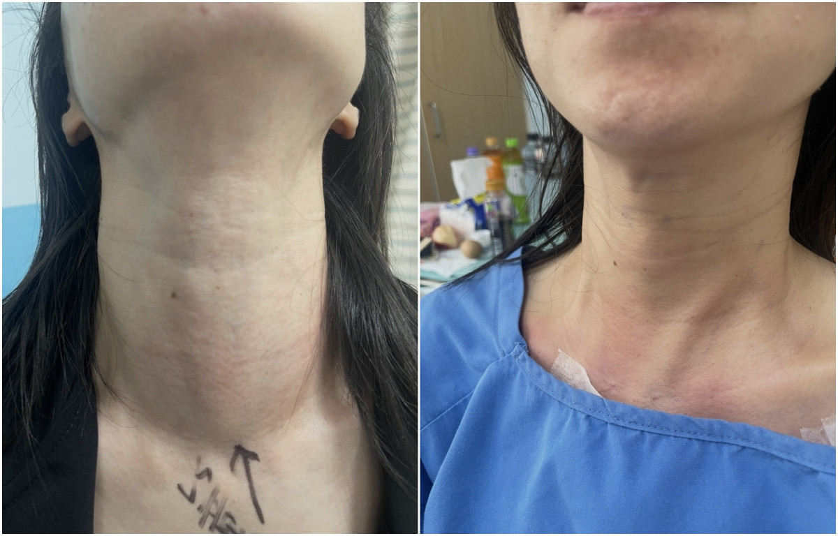 部桃達文西再突破　甲狀腺手術破百例