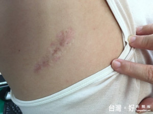 陳姓婦人罹患帶狀泡疹，是民間所說的「飛蛇」症，痛得不能入眠

，經大甲李綜合醫院神經內科張峻誠醫師治癒後，仍留下疤痕。（記者陳榮昌攝）