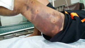 仍列為狂犬病疫區的雲林縣古坑鄉一名老婦遭流浪狗圍攻咬傷雙腿、臀部、背部等多處。（記者簡勇鵬翻攝）