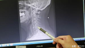 ▲病人術前X光照，可發現頸椎椎間盤壓迫。（圖／七賢脊椎外科醫院提供）