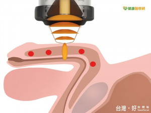 威而鋼也莫法度？　體外震波讓「性」福滿分