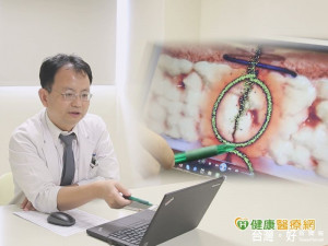 WHO：三氯沙塗層抗菌縫線可降低感染風險