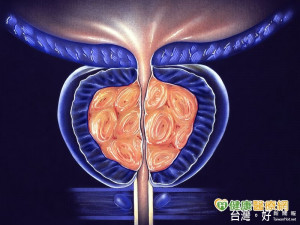 攝護腺肥大困擾老男人　中醫有這些方法可改善