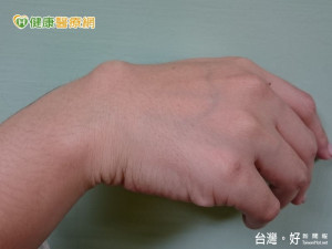 腱鞘囊腫大如棒棒糖　該怎麼治療？