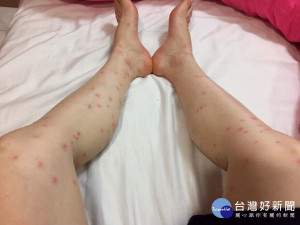 被蚊子叮的如紅豆冰。林重鎣攝