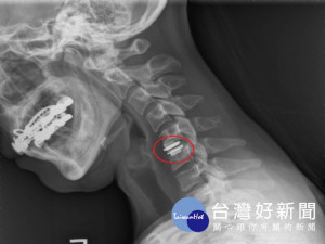 大甲李綜合醫院院長暨神經外科權威醫師張迪生，為老榮民施以「微

創腰椎手術」，隔天即可不需戴頸圈自由的活動。（記者陳榮昌攝）