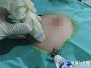 乳房微創手術。林重鎣翻攝