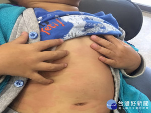 黃小弟的麻疹。林重鎣攝