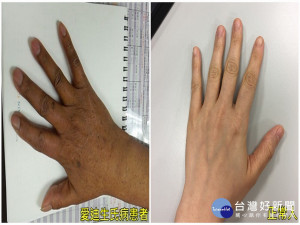 黑手掌和正常手掌。林重鎣攝