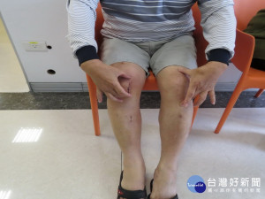 機器手臂開膝安全又恢復快。林重鎣攝