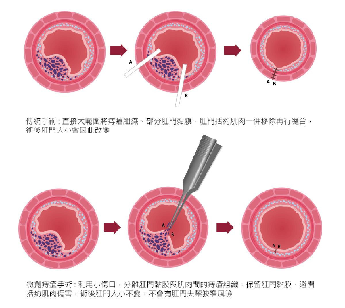 傳統手術與微創痔瘡手術的方式比較。（圖／禾馨直腸外科）