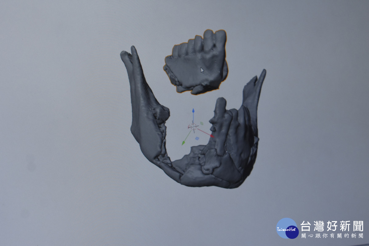 許家浚醫師透過3D模擬技術及醫療3D列印輔助，重建劉同學下顎。