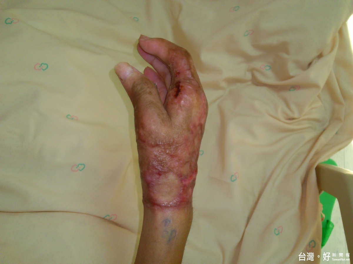 圖片說明1：遭機器捲入造成嚴重撕脫傷的手，經高壓氧治療後恢復 狀況良好。