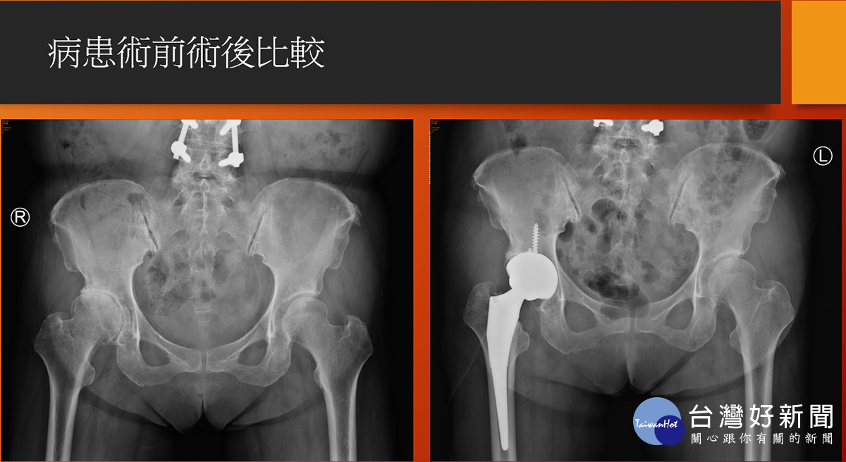 正前開式髖部手術　改善病患多年髖部疼痛老症頭