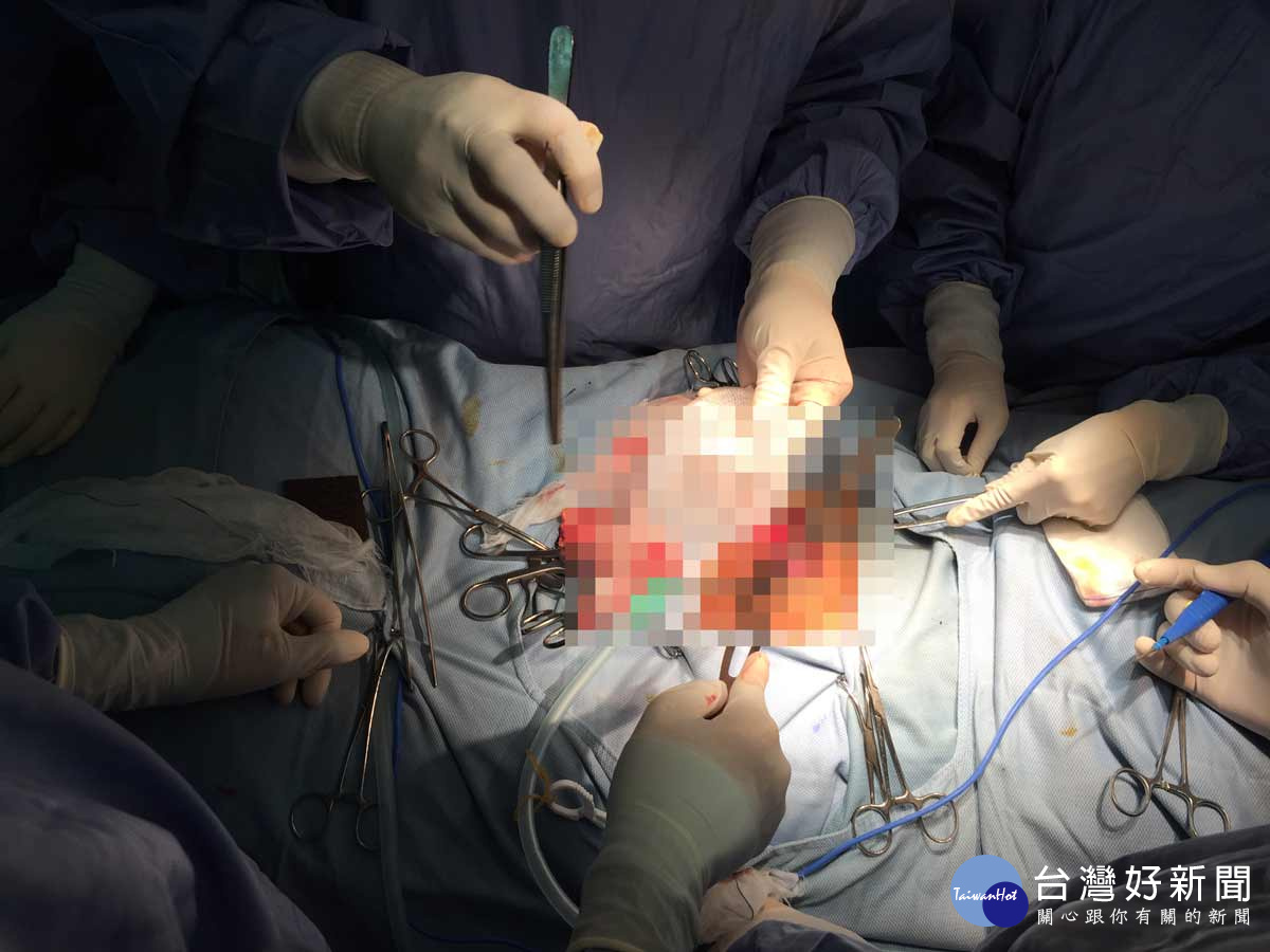 疝氣手術新紀元　經皮修補免用腹腔鏡