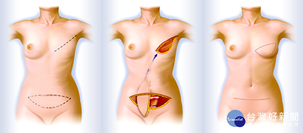 自體組織重建以腹直肌橫向皮瓣最常使用，也是皮瓣組織重建的首選，疤痕位置在下腹，可以隱藏在內褲裡。