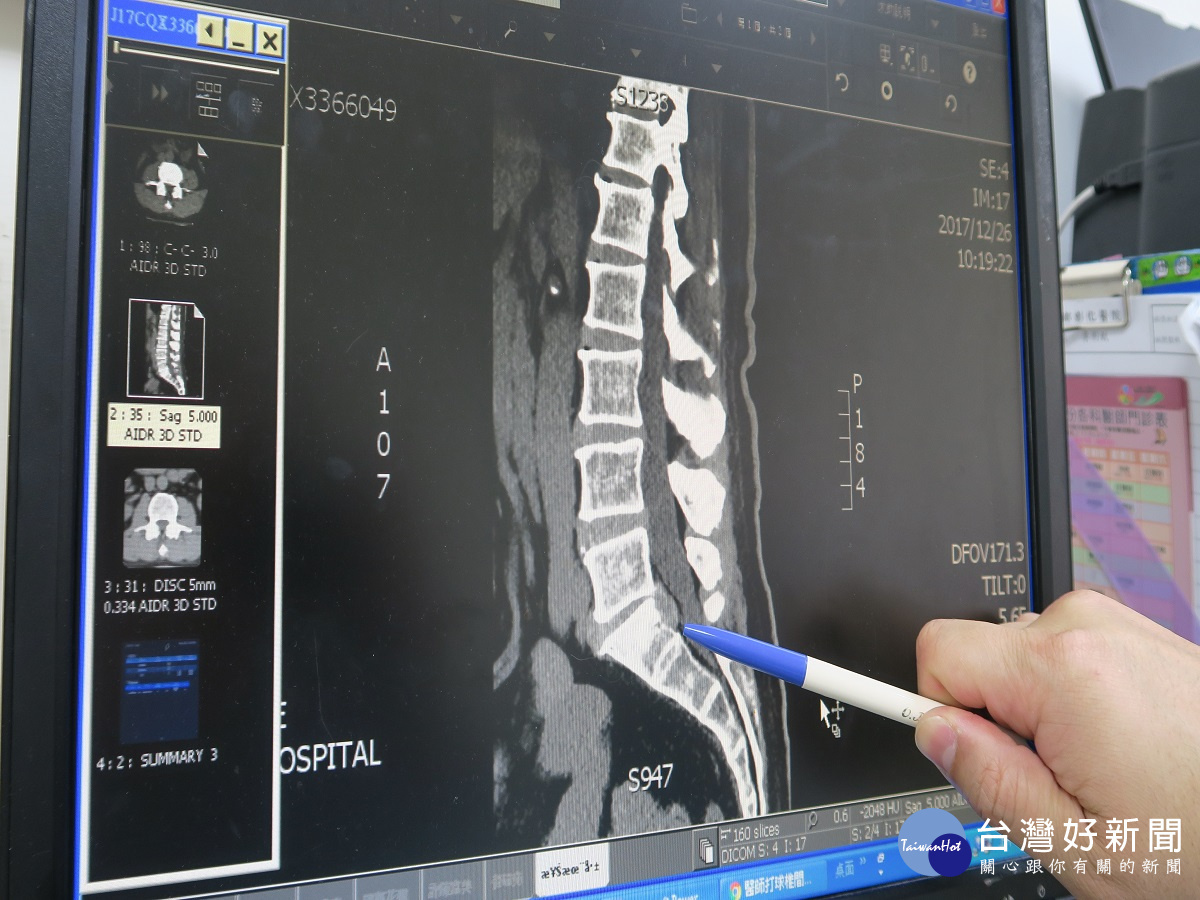 老翁搬重物椎間盤破裂痛2個月 新型內視鏡手術隔天就出院