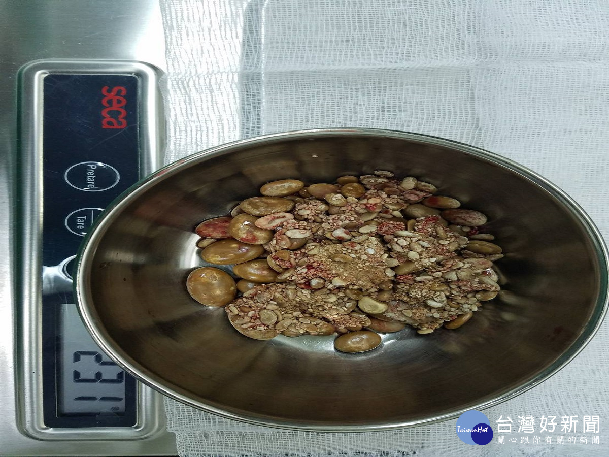 高齡老翁血尿就醫 檢查膀胱竟有「幾堆」石頭